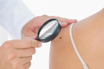 Tratamento do Melanoma – Cientistas podem deter o câncer de pele