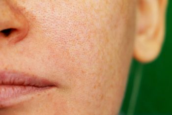 Melasma: o que é e como tratar